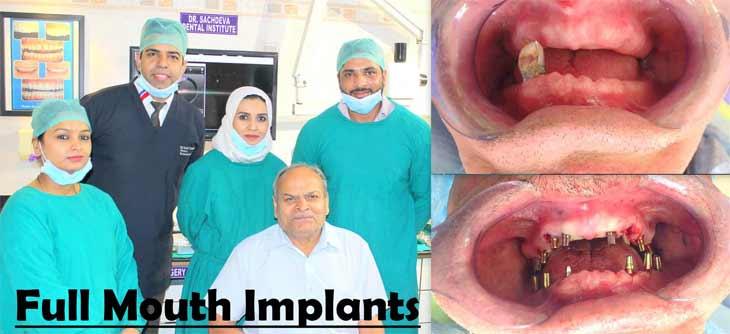 dental-implant-clinic-in-delhi-ashok-vihar