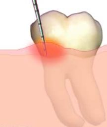 dental-implant-in-india-dentalimplantindia