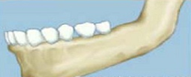 dental implant india