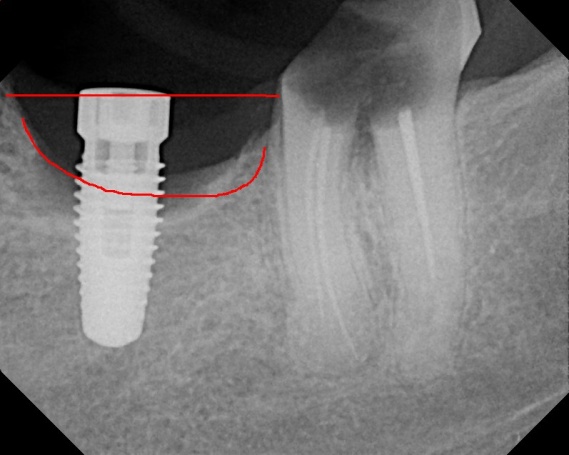 dental implants in india