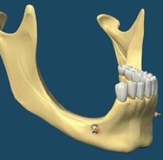 dental implants in india