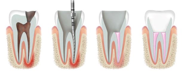 Root Canal Treatment All You Need To Know Dentalimplantindia