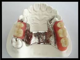 Cast Partial Denture