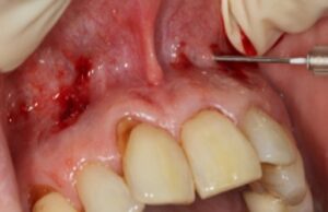 what is pinhole gum surgery