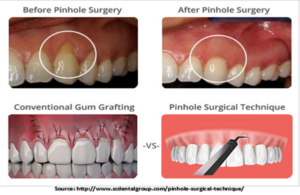 procedure for pin hole gum surgery