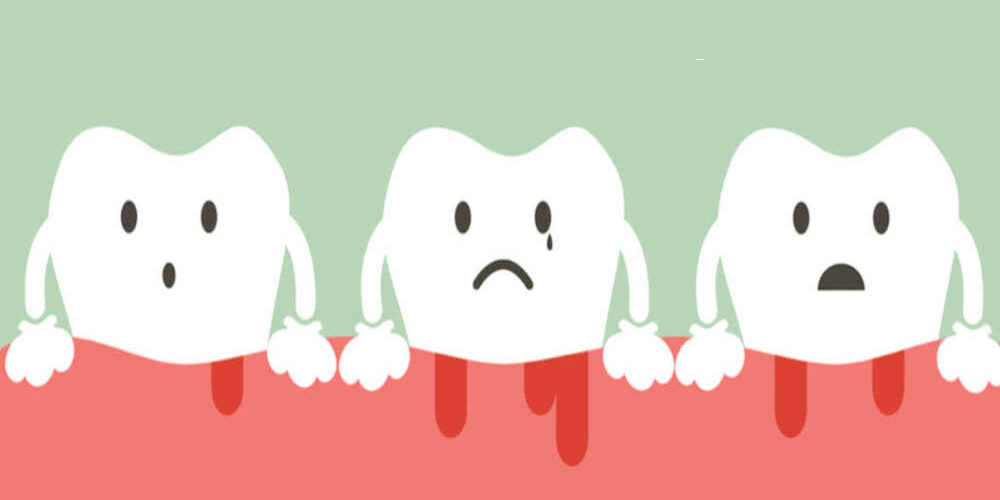 alternative-treatment-for-periodontitis-anterior-maxilla