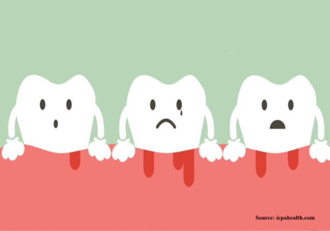 alternative-treatment-for-periodontitis-anterior-maxilla