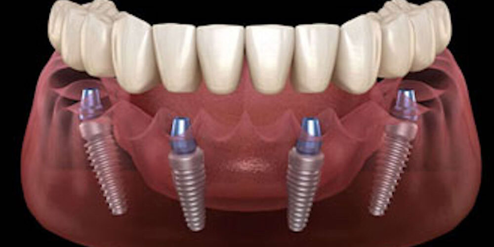 dental-implant-1