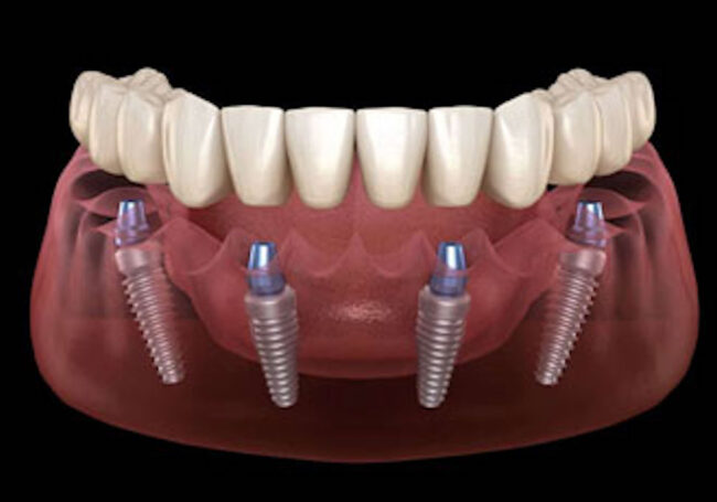 dental-implant-1
