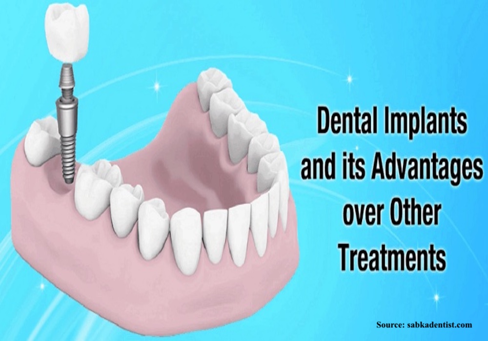 Advantages of implants - dentalimplantindia