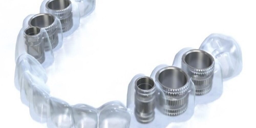 implants-without-surgery