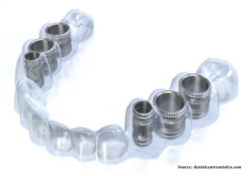 implants-without-surgery