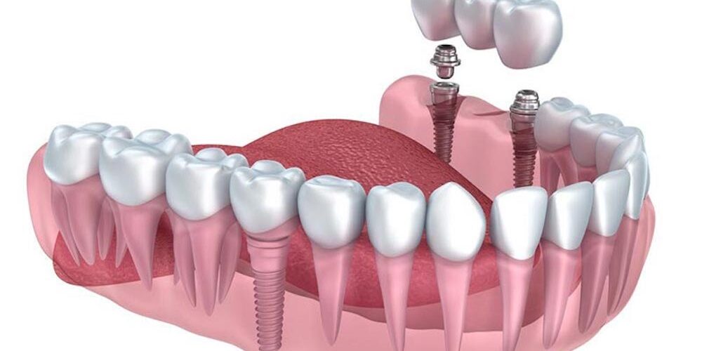 dental-implant-options