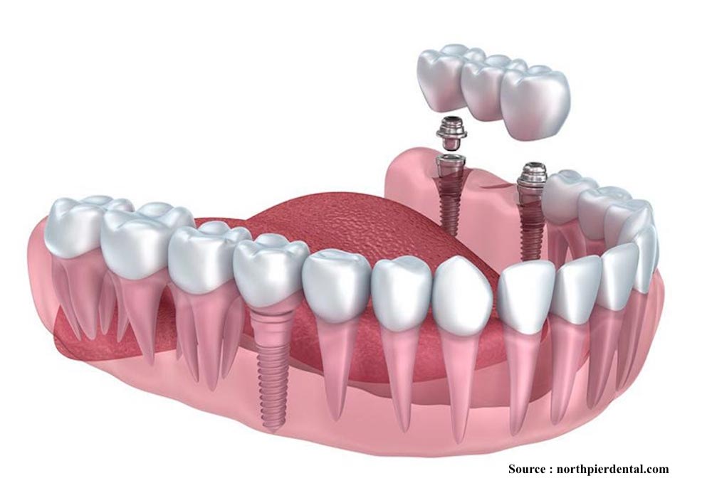 dental-implant-options