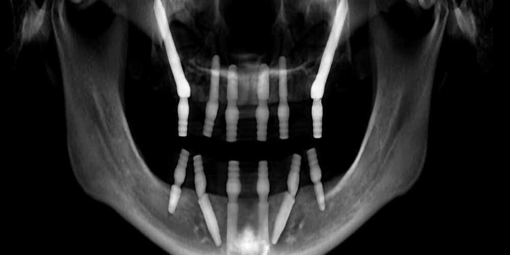 zygomatic-implants-highlighted