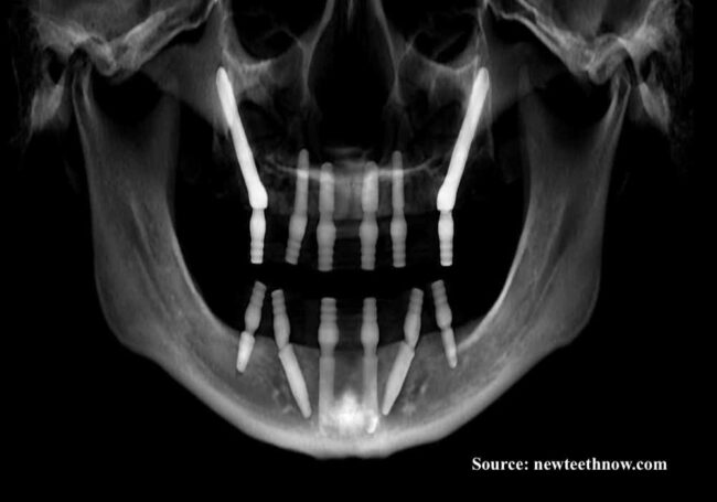 zygomatic-implants-highlighted