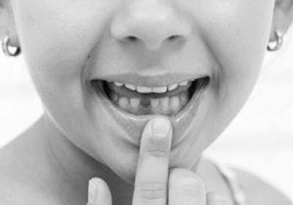 what-to-do-when-a-child-loses-a-tooth-dentalimplantindia