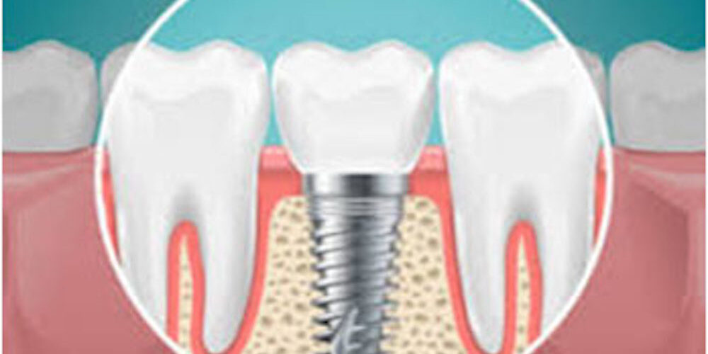 dental-implant