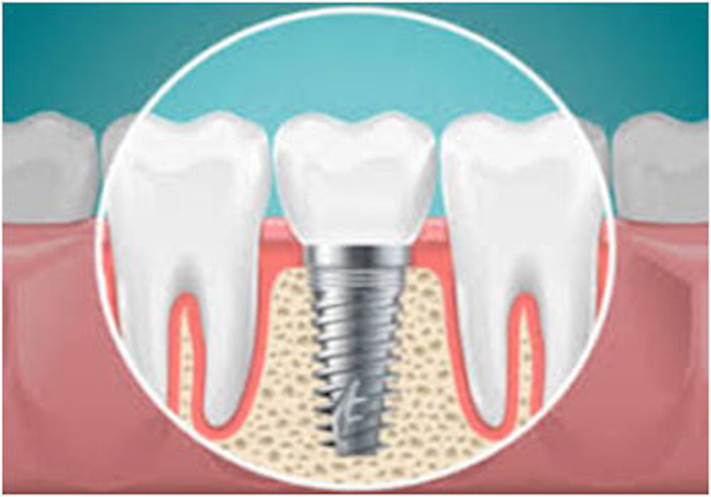 dental-implant