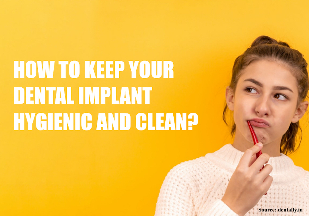 dental-implant