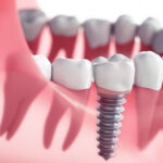 Dental Implant