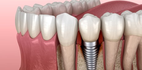 Picture1 dental treatments