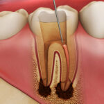 Root Canal