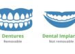 dentures vs dental implants
