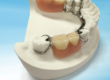 Cast Partial Denture