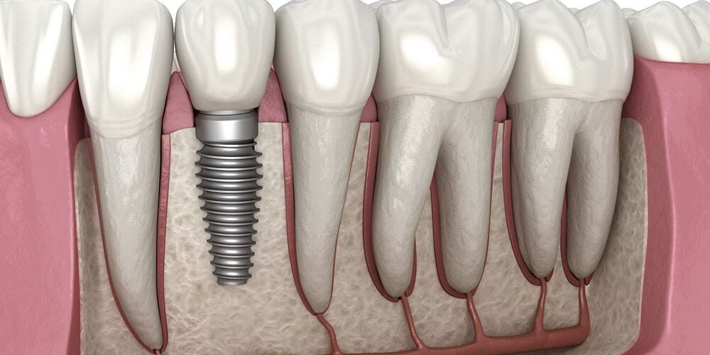 Dental Implants Dental Implants