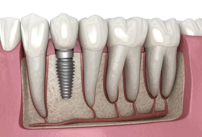 Dental Implants Dental Implants