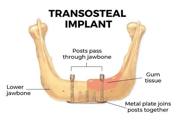Tranosteal Implant
