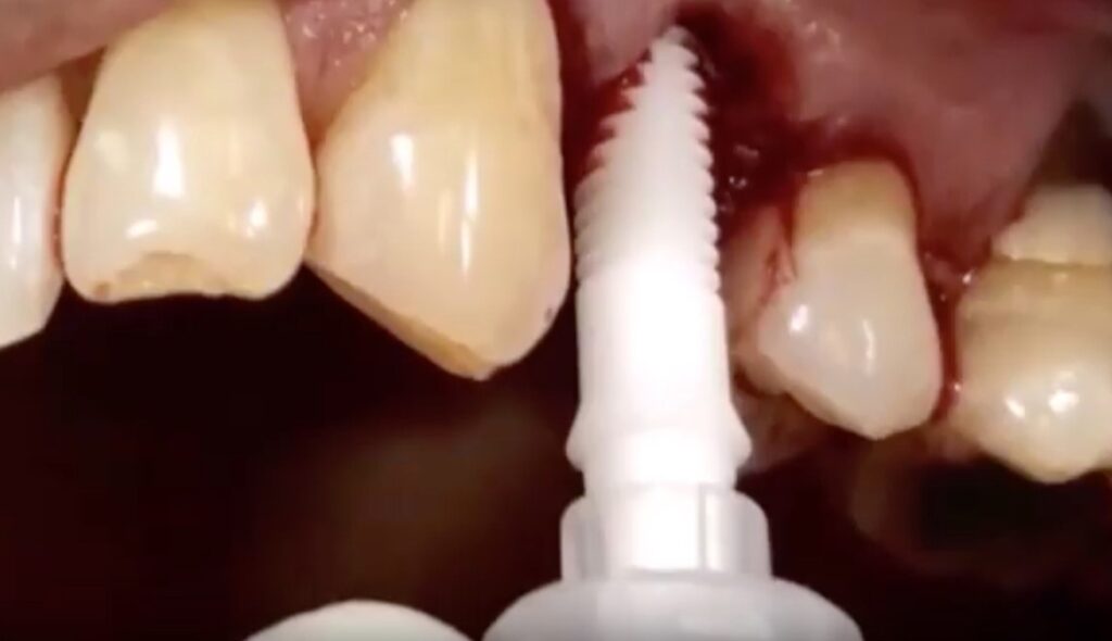 Easy to place on gums
