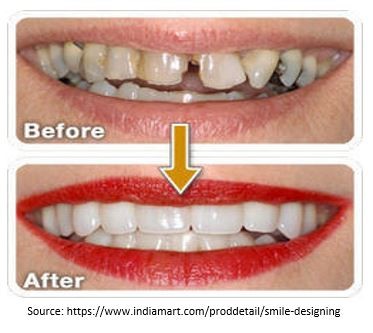 Overview of Smile Designing