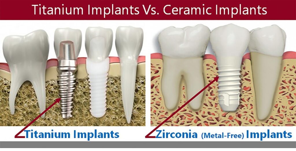 titanium Implants