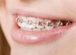 Dental Braces