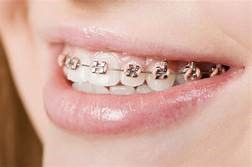 Dental Braces Dental Braces