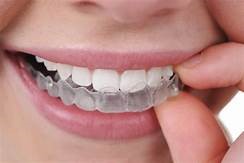 Invisalign and Clear Aligners