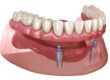 Overdentures