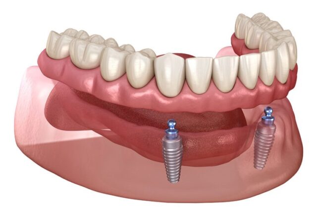 Overdentures Overdentures