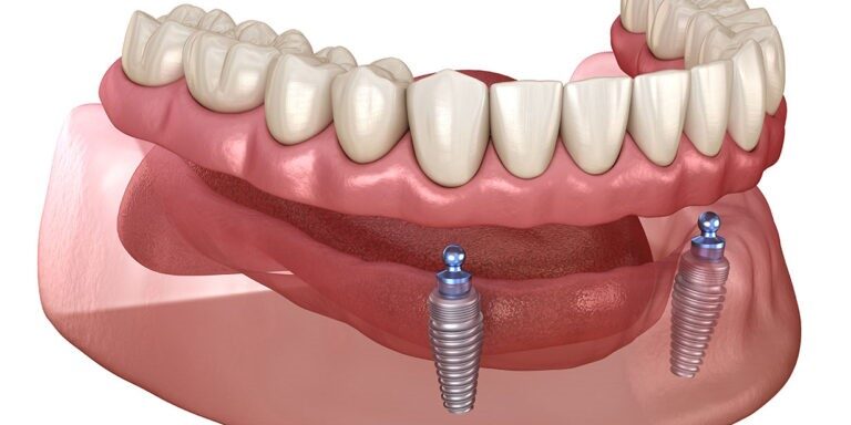 Overdentures Overdentures