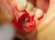Peri- implantitis