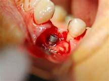 Peri- implantitis Peri- implantitis
