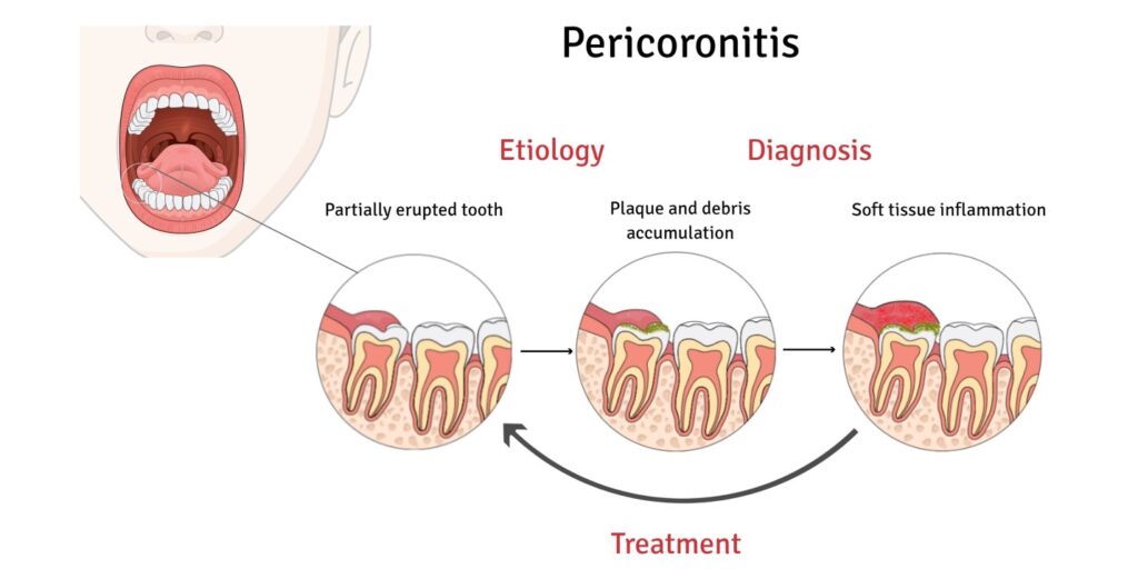 Pericoronitis