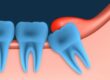 Pericoronitis Management
