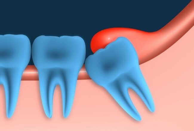Pericoronitis Management Pericoronitis Management
