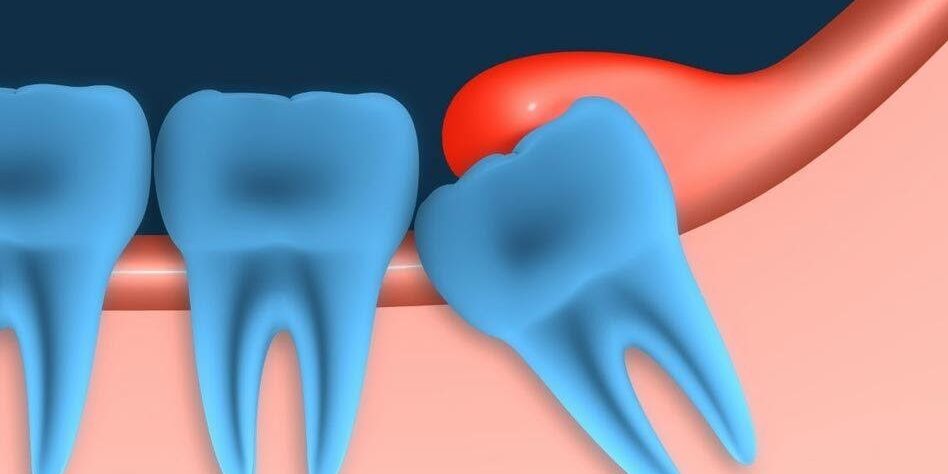 Pericoronitis Management Pericoronitis Management