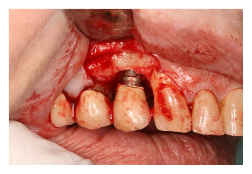 prevalence of peri-implantitis