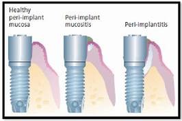treat peri-implantitis