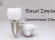 Basal Implant vs. Conventional Implant
